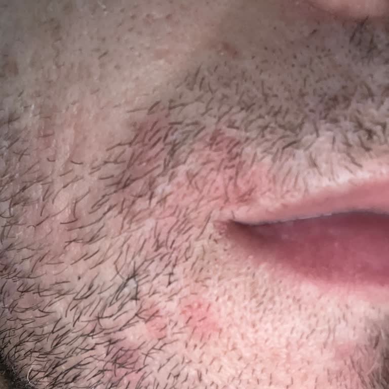 Pazarama’dan Alınan Şampuan Sonrası Ciddi Alerjik Reaksiyon Ve Sahte Ürün Şüphesi