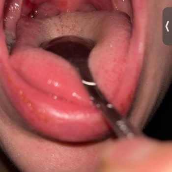 Ameliyat Sonrası Anestezi Kaynaklı Boğaz Yaralanması Ve Hastane İlgisizliği