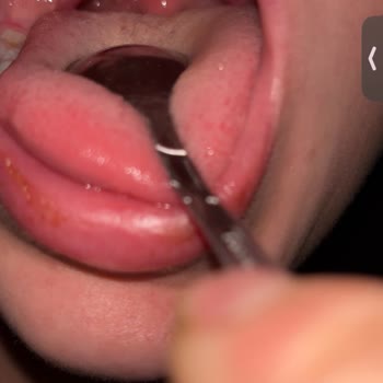 Ameliyat Sonrası Anestezi Kaynaklı Boğaz Yaralanması Ve Hastane İlgisizliği