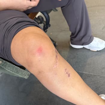 Urla Bamboo AVM’de Kaygan Zeminde Düşerek Ciddi Şekilde Yaralandım Destek Alamadım