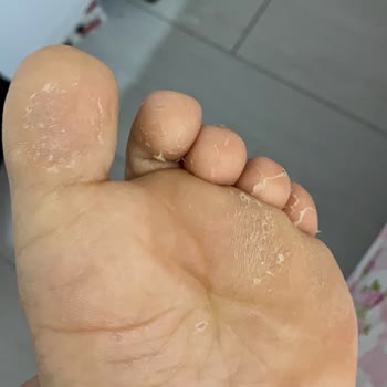 Kısa Sürede Deforme Olan Ayakkabı Sağlığımı Olumsuz Etkiledi, Çözüm Bekliyorum