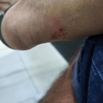 Kısa Sürede Ayağımı Yaralayan Terlik İçin İade Talebim Reddedildi