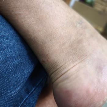 Kısa Sürede Ayağımı Yaralayan Terlik İçin İade Talebim Reddedildi