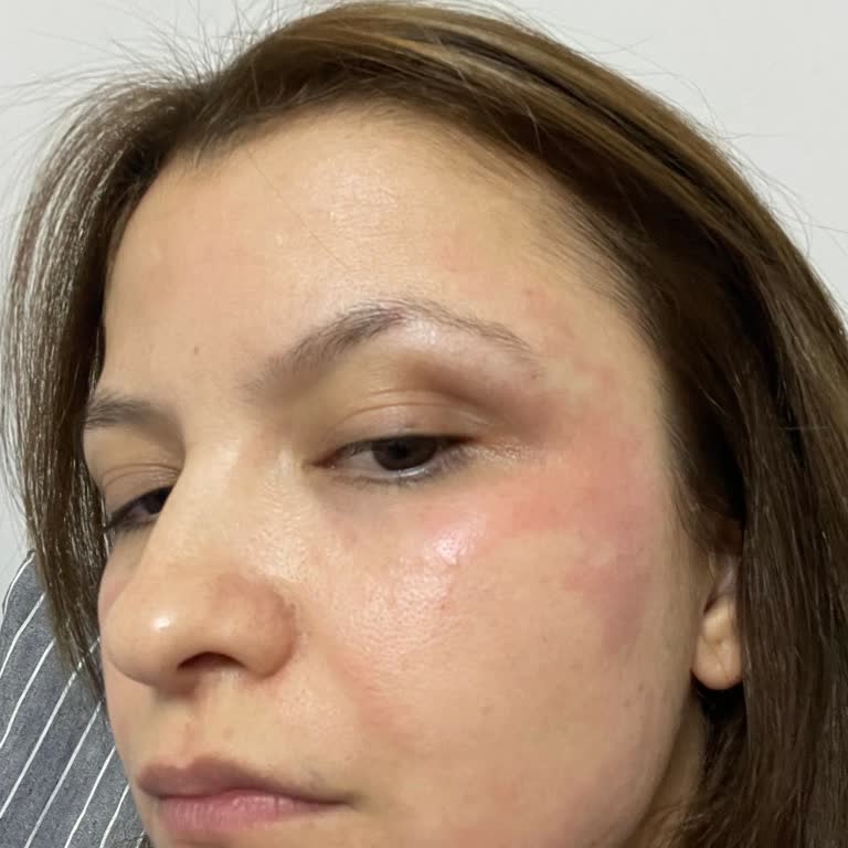 Loreal Revitalift Lazer Retinol Kullanımı Sonrası Ciddi Cilt Reaksiyonu Ve Mağduriyet