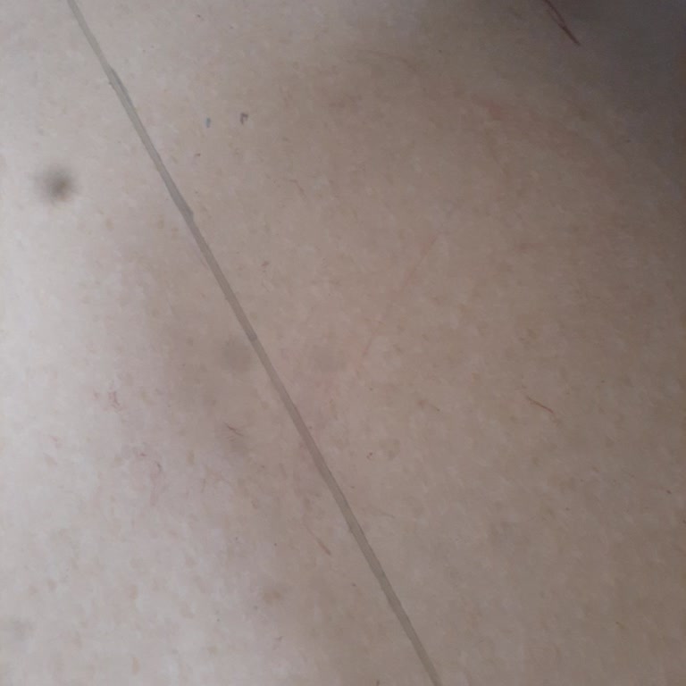 City Hospital 'de Acemi Hemşire Nedeniyle Yaşanan Mağduriyet