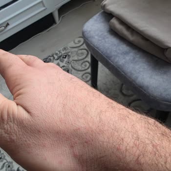 Alerjik Reaksiyon Ve Yetersiz Bilgilendirme Nedeniyle Mağduriyet Yaşadım