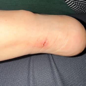 Skechers Ayakkabı Ciddi Tahriş Ve Garanti Sorunu Yaşattı