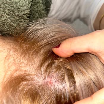 Saç Boyası Alerji Ve Yanlış Renk Sonucu Büyük Mağduriyet Yaşadım