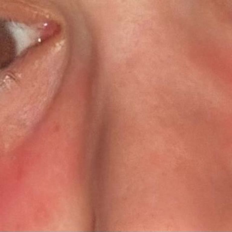 Lancome Serum Kremi Cildimde Ciddi Tahriş Ve Kızarıklık Yaptı