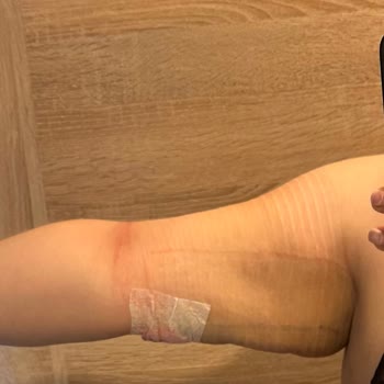 Estetik İşlem Sonrası Kötü Sonuç Ve İlgisizlik Nedeniyle Mağduriyet Yaşadım