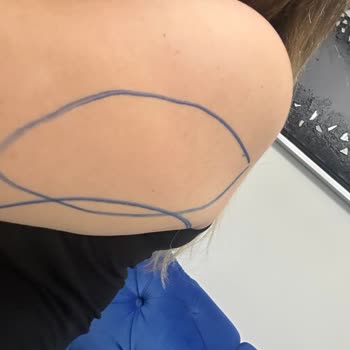 Estetik İşlem Sonrası Kötü Sonuç Ve İlgisizlik Nedeniyle Mağduriyet Yaşadım