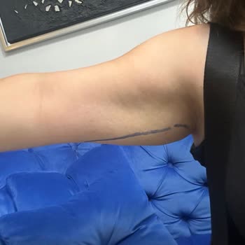 Estetik İşlem Sonrası Kötü Sonuç Ve İlgisizlik Nedeniyle Mağduriyet Yaşadım