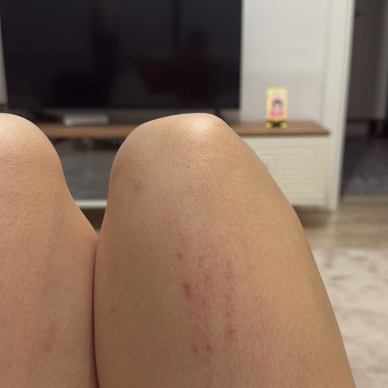 Lucita Güzellik Sefaköy Şubesinde Lazer Epilasyon Sonrası Tahriş Ve İletişim Sorunu