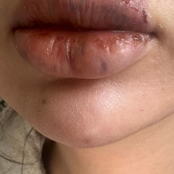 Mehrzad Clinic'te Dolgu Sonrası Nekroz