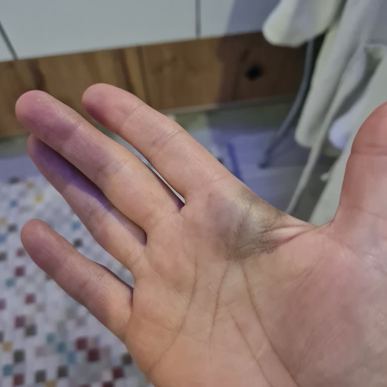 Meyve Suyu Kapağı Patladı Elim Morardı Büyük Tehlike Atlattım