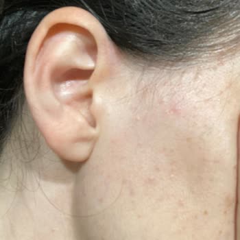 Elidor Şampuan Kullanımı Sonrası Ciltte Ve Saç Derisinde Alerjik Reaksiyon