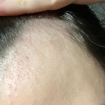 Elidor Şampuan Kullanımı Sonrası Ciltte Ve Saç Derisinde Alerjik Reaksiyon