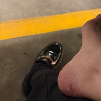 Bir Kez Giyilen Lüks Ayakkabı Ciddi Yara Yaptı, İade Reddedildi