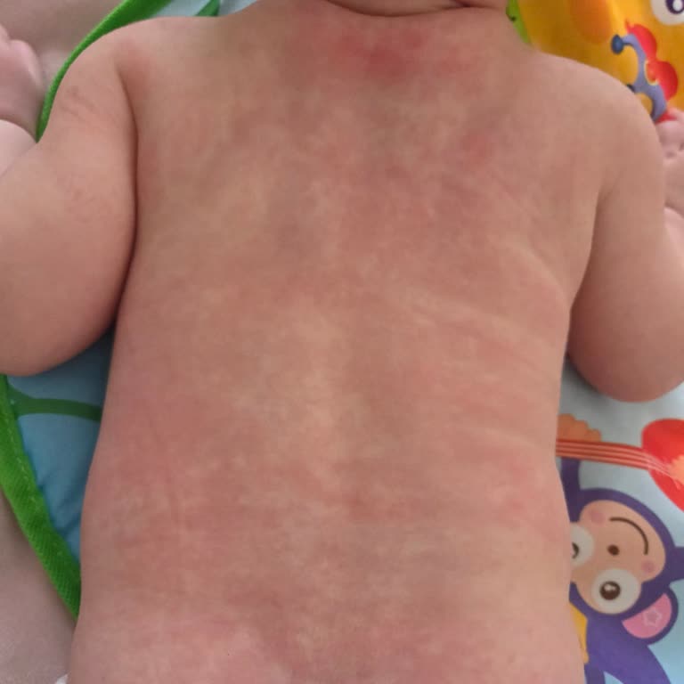 Vegaferon İlacın Ciddi Yan Etkisini Gördük