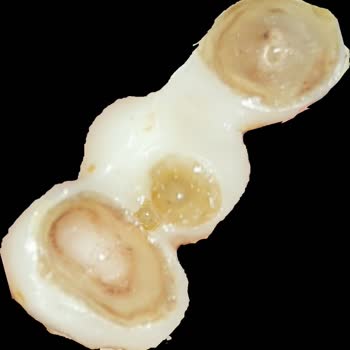 Dental Clinic Tedavi Sonrası Diş Kaybı, İlgisizlik ve Güvenlik Endişesiyle Mağduriyet Yaşadım