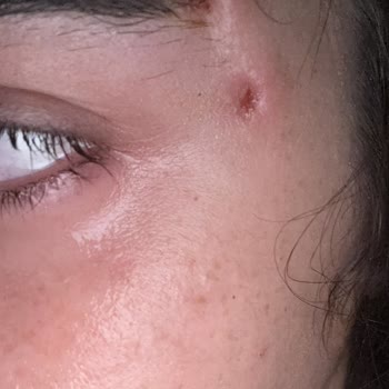 İşlem Sonrası Asimetri, İyileşme Sorunu Ve İletişimsizlik Nedeniyle Mağduriyet