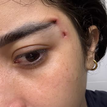 İşlem Sonrası Asimetri, İyileşme Sorunu Ve İletişimsizlik Nedeniyle Mağduriyet