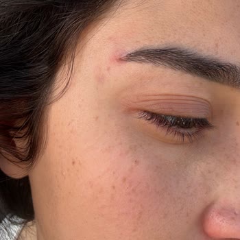 İşlem Sonrası Asimetri, İyileşme Sorunu Ve İletişimsizlik Nedeniyle Mağduriyet