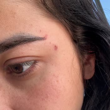 İşlem Sonrası Asimetri, İyileşme Sorunu Ve İletişimsizlik Nedeniyle Mağduriyet