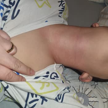 Berko İlaç Çocuğumda İburamin Cold Şurubu Sonrası Şiddetli Alerjik Reaksiyon Gelişti