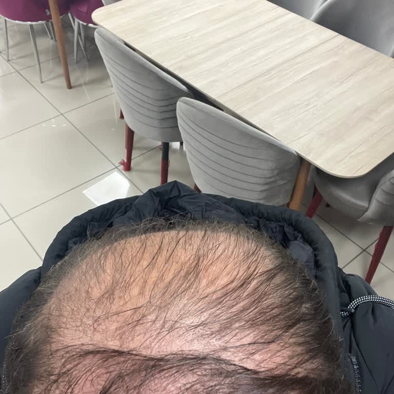 Saç Ekimi Sonrası Beklenen Sonucun Alınamaması Ve Yetersiz Çözüm Önerisi