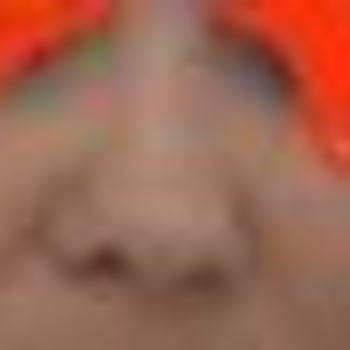 Başarısız Burun Estetiği Sonrası Artan Şekil Bozuklukları Ve Mağduriyet