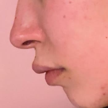 Dudak Dolgusu İşlemi Sonrası Mağduriyet Ve Güven Kaybı Yaşadım