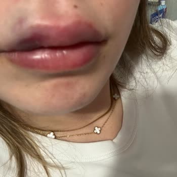 Dudak Dolgusu İşlemi Sonrası Mağduriyet Ve Güven Kaybı Yaşadım