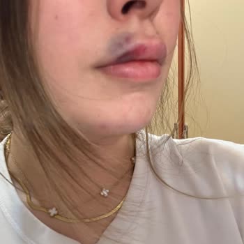 Dudak Dolgusu İşlemi Sonrası Mağduriyet Ve Güven Kaybı Yaşadım