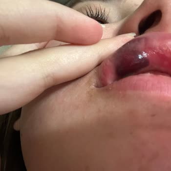 Dudak Dolgusu İşlemi Sonrası Mağduriyet Ve Güven Kaybı Yaşadım