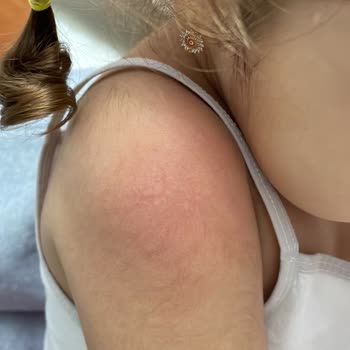 Bebek Şampuanı Alerji Ve Döküntü Yaptı, İade Talebim Var