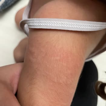 Bebek Şampuanı Alerji Ve Döküntü Yaptı, İade Talebim Var