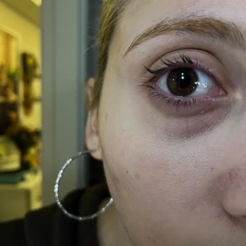 Güzellik Salonunda Hijyen Ve Güvenlik Sorunu Nedeniyle Göz Sağlığım Zarar Gördü