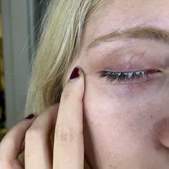 Güzellik Salonunda Hijyen Ve Güvenlik Sorunu Nedeniyle Göz Sağlığım Zarar Gördü