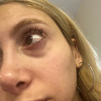 Güzellik Salonunda Hijyen Ve Güvenlik Sorunu Nedeniyle Göz Sağlığım Zarar Gördü