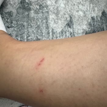 Aldığım Ayakkabı Ayağımı Yaraladı, İade Talebim Haksız Yere Reddedildi