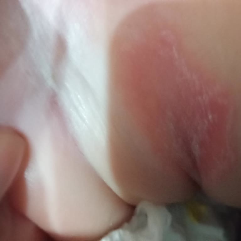 Molfix Bebek Bezinde Alerji Ve Sızdırma Sorunu Bebeğimin Sağlığını Etkiledi