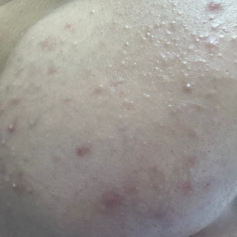 Yüz Tüy Alma Cihazı Sonrası Cildimde Beklenmedik Reaksiyonlar Oluştu