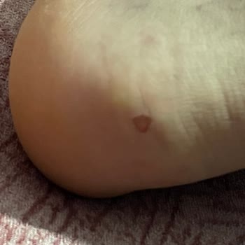 In Street Kısa Sürede Deforme Olan Ayakkabı Ayağımı Yaraladı Talebim Reddedildi