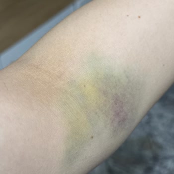 Kan Alma Sırasında Yaşanan Ciddi İhmal Ve Mağduriyet