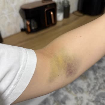 Kan Alma Sırasında Yaşanan Ciddi İhmal Ve Mağduriyet