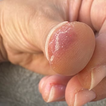 Ojely Parmaklarımda Kızarıklık, Şişme Ve Kaşıntı Meydana Geldi