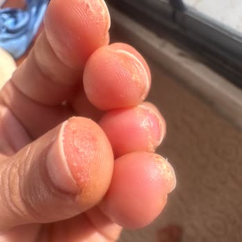 Ojely Parmaklarımda Kızarıklık, Şişme Ve Kaşıntı Meydana Geldi