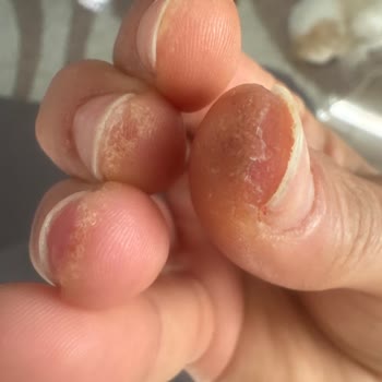 Ojely Parmaklarımda Kızarıklık, Şişme Ve Kaşıntı Meydana Geldi