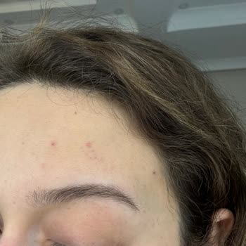 Sebium Yüz Yıkama Jeli Cildimde Alerjik Reaksiyona Sebep Oldu